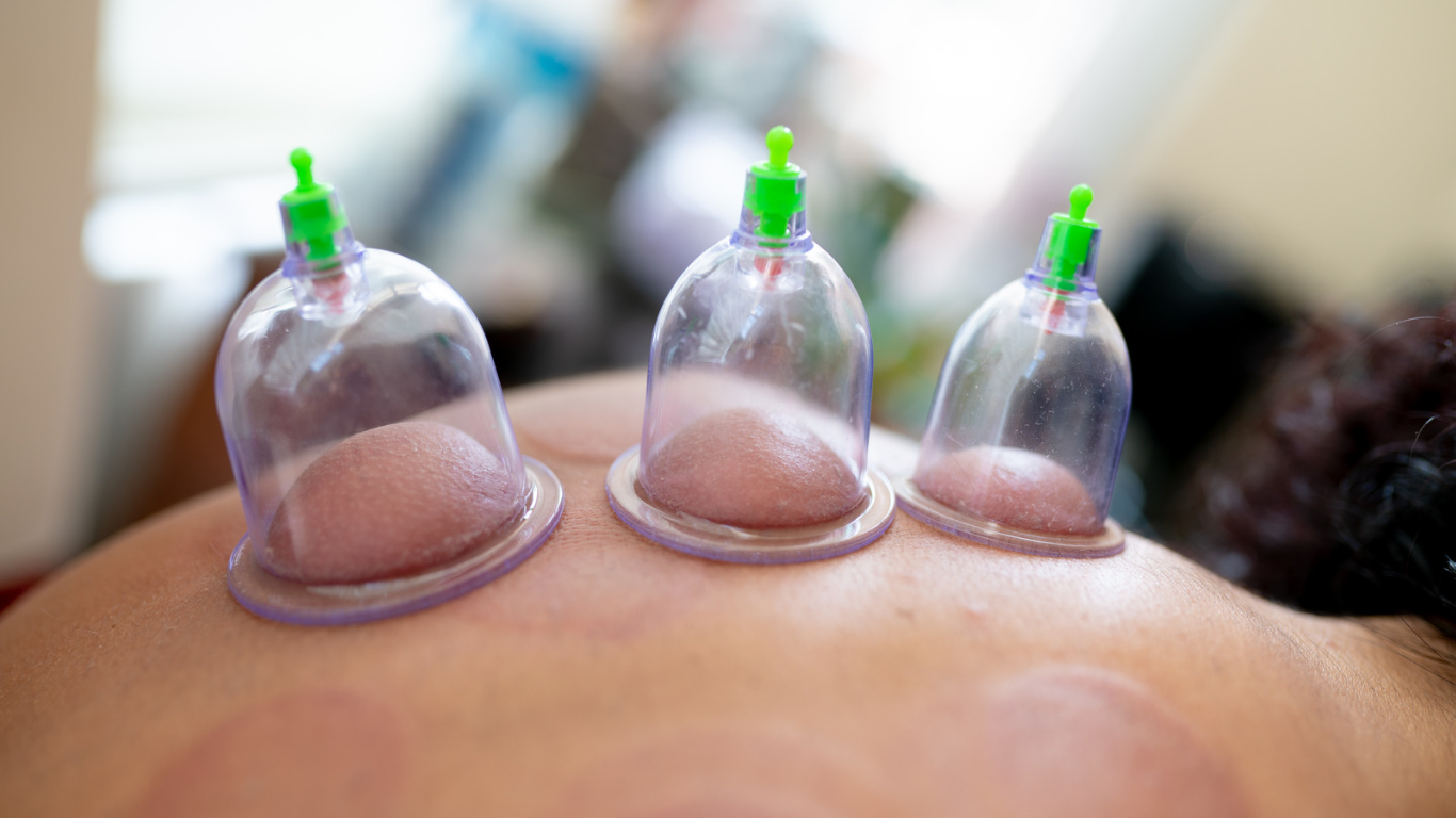 Benefits pf Hijama Cupping Therapy at Holistic Health Hijama Pune